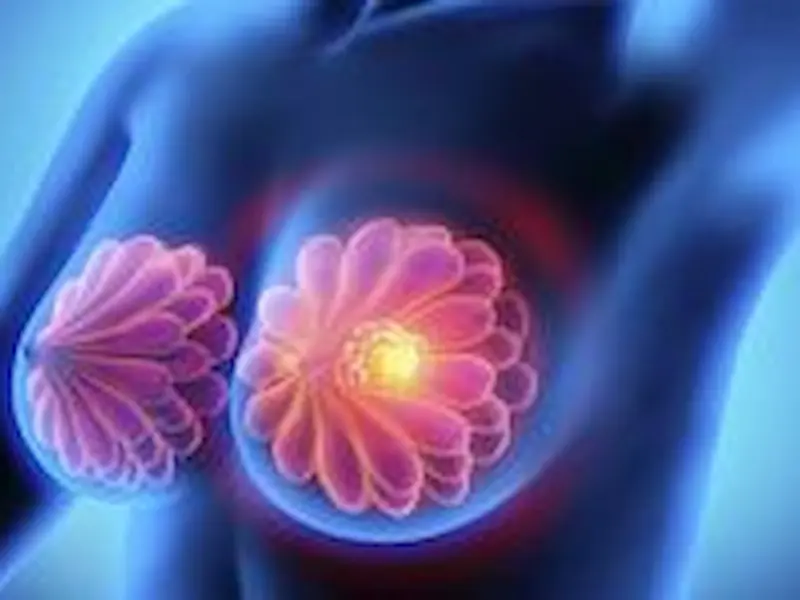 Mengenal Jenis Kanker Payudara yang Sering Terjadi